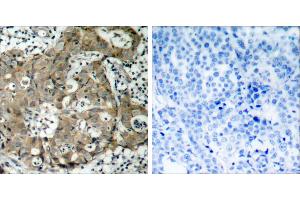Peptide - +Immunohistochemical analysis of paraffin-embedded human breast carcinoma tissue using FKHR (Ab-319) antibody (#B7086). (FOXO1 Antikörper  (Ser319))