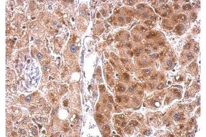 IHC-P Image StAR antibody detects StAR protein at cytosol on human hepatoma by immunohistochemical analysis. (STAR Antikörper)