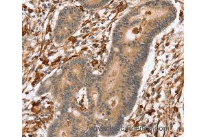 Immunohistochemistry of Human colon cancer using SSX2IP Polyclonal Antibody at dilution of 1:45 (SSX2IP Antikörper)