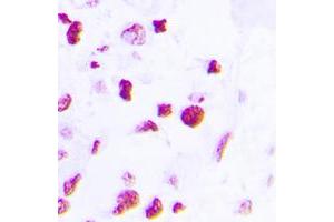 Immunohistochemical analysis of C/EBP beta staining in human lung cancer formalin fixed paraffin embedded tissue section. (CEBPB Antikörper  (C-Term))