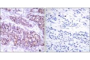 Immunohistochemistry analysis of paraffin-embedded human breast carcinoma, using BCL-XL (Phospho-Ser62) Antibody. (BCL2L1 Antikörper  (pSer62))