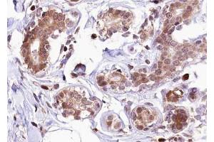 Immunohistochemistry (IHC) image for anti-Estrogen Receptor 1 (ESR1) (pSer118) antibody (ABIN6254948)