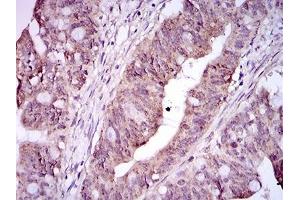 Immunohistochemical analysis of paraffin-embedded rectum cancer tissues using ITGA2B mouse mAb with DAB staining. (Integrin Alpha2b Antikörper  (AA 45-149))