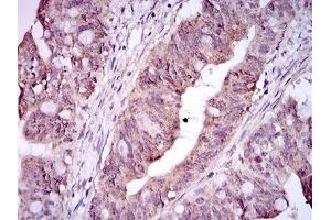 Immunohistochemical analysis of paraffin-embedded rectum cancer tissues using ITGA2B mouse mAb with DAB staining.