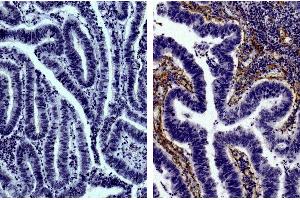 Paraffin embedded human gastric cancer tissue was stained with Goat IgG-UNLB isotype control, DAB, and hematoxylin. (Schwein anti-Ziege IgG (Heavy & Light Chain) Antikörper (FITC))