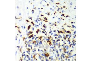 Immunohistochemistry of paraffin-embedded human liver cancer using CAPG Antibody (ABIN6132242, ABIN6137908, ABIN6137909 and ABIN7101810) at dilution of 1:100 (40x lens). (CAPG Antikörper  (AA 1-348))