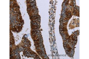 Immunohistochemistry of Human colon cancer using HMGCL Polyclonal Antibody at dilution of 1:30