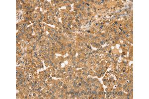 Immunohistochemistry of Human breast cancer using STX10 Polyclonal Antibody at dilution of 1:35 (Syntaxin 10 Antikörper)