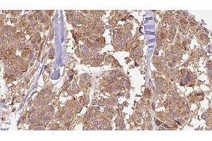 ABIN6274897 at 1/100 staining Human Melanoma tissue by IHC-P.