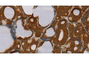 Immunohistochemistry of paraffin-embedded Human thyroid cancer tissue using PARP3 Polyclonal Antibody at dilution 1:40 (PARP3 Antikörper)