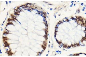 Immunohistochemistry of paraffin-embedded Human colon carcinoma using SNIP1 Polyclonal Antibody at dilution of 1:100 (40x lens). (SNIP1 Antikörper)