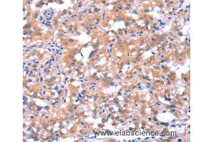 Immunohistochemistry of Human thyroid cancer using FAT1 Polyclonal Antibody at dilution of 1:40 (FAT1 Antikörper)