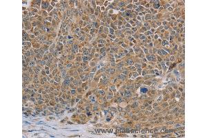 Immunohistochemistry of Human ovarian cancer using NDUFS7 Polyclonal Antibody at dilution of 1:40 (NDUFS7 Antikörper)