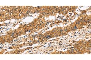 Immunohistochemistry of paraffin-embedded Human gasrtic cancer tissue using CD22 Polyclonal Antibody at dilution 1:50 (CD22 Antikörper)