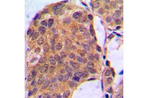Immunohistochemical analysis of ERK1/2 staining in human breast cancer formalin fixed paraffin embedded tissue section. (ERK1/2 Antikörper  (C-Term))