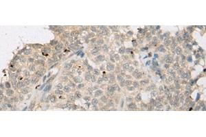Immunohistochemistry of paraffin-embedded Human ovarian cancer tissue using ZNF449 Polyclonal Antibody at dilution of 1:50(x200) (ZNF449 Antikörper)