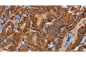 Immunohistochemistry of paraffin-embedded Human thyroid cancer tissue using MBNL3 Polyclonal Antibody at dilution 1:30 (MBNL3 Antikörper)