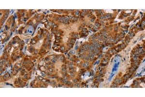 Immunohistochemistry of paraffin-embedded Human thyroid cancer tissue using MBNL3 Polyclonal Antibody at dilution 1:30