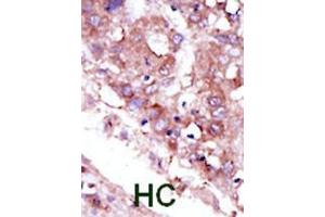 Formalin-fixed and paraffin-embedded human cancer tissue reacted with the primary antibody, which was peroxidase-conjugated to the secondary antibody, followed by DAB staining. (STK33 Antikörper  (C-Term))