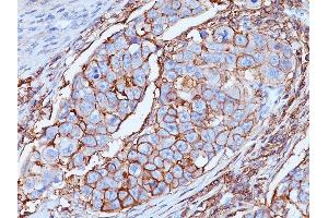 Formalin-fixed, paraffin-embedded human Breast tissue stained with CD44 Mouse Monoclonal Antibody (DF1485). (CD44 Antikörper)