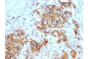 Formalin-fixed, paraffin-embedded human gastric carcinoma stained with CA19-9 antibody (121SLE). (CA 19-9 Antikörper)