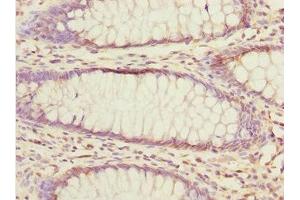 Immunohistochemistry of paraffin-embedded human colon cancer using ABIN7152363 at dilution of 1:100