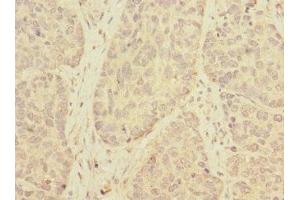 Immunohistochemistry of paraffin-embedded human ovarian cancer using ABIN7173139 at dilution of 1:100 (FAM156A Antikörper  (AA 251-519))