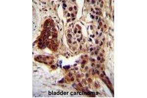 CCDC122 antibody (C-term) immunohistochemistry analysis in formalin fixed and paraffin embedded human bladder carcinoma followed by peroxidase conjugation of the secondary antibody and DAB staining. (CCDC122 Antikörper  (C-Term))