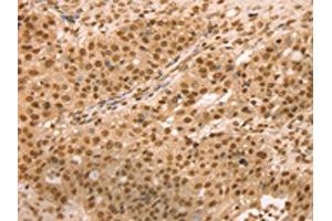 The image on the left is immunohistochemistry of paraffin-embedded Human breast cancer tissue using ABIN7131133(SNX8 Antibody) at dilution 1/25, on the right is treated with fusion protein. (SNX8 Antikörper)