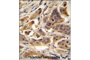 RBCK1 (UBCE7IP3) Antibody (N-term) A immunohistochemistry analysis in formalin fixed and paraffin embedded human bladder carcinoma followed by peroxidase conjugation of the secondary antibody and DAB staining. (RBCK1 Antikörper  (N-Term))