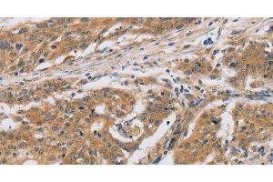 Immunohistochemistry of paraffin-embedded Human ovarian cancer tissue using CST6 Polyclonal Antibody at dilution 1:30 (CST6 Antikörper)