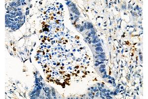 ABIN6261740 and ABIN6278462 at 1/100 staining Human colorectal cancer by IHC-P.