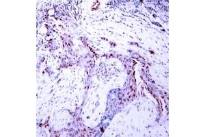 Immunohistochemical analysis of paraffin- embedded human breast carcinoma tissue, using Progesterone Receptor (phospho-Ser190) antibody (E011074). (Progesterone Receptor Antikörper  (pSer190))