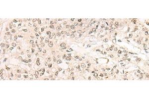 Immunohistochemistry of paraffin-embedded Human prost ate cancer tissue using WEE1 Polyclonal Antibody at dilution of 1:35(x200) (WEE1 Antikörper)