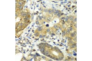 Immunohistochemistry of paraffin-embedded human gastric cancer using DPP3 antibody. (DPP3 Antikörper  (AA 1-280))