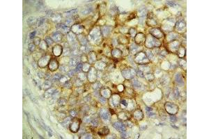 IHC-P: Caspase-6 antibody testing of human breast cancer tissue (Caspase 6 Antikörper  (AA 24-44))