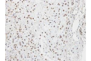 IHC-P Image Immunohistochemical analysis of paraffin-embedded A549 xenograft, using LZIP, antibody at 1:100 dilution.