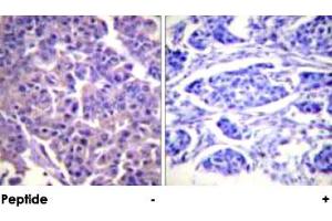Immunohistochemical analysis of paraffin-embedded human breast carcinoma tissue using CALD1 polyclonal antibody . (Caldesmon Antikörper)