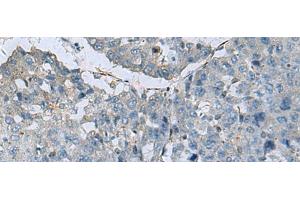 Immunohistochemistry of paraffin-embedded Human liver cancer tissue using GLS Polyclonal Antibody at dilution of 1:70(x200) (Glutaminase Antikörper)