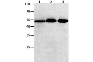 Western Blot analysis of Human lymphoma , ovarian and colon cancer tissue using KLF5 Polyclonal Antibody at dilution of 1:350 (KLF5 Antikörper)