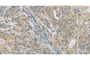Immunohistochemistry of paraffin-embedded Human gasrtic cancer tissue using PKD1 Polyclonal Antibody at dilution 1:40 (PKD1 Antikörper)