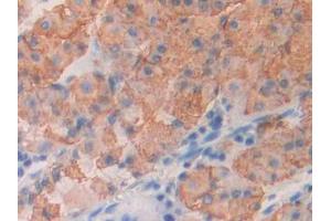 DAB staining on IHC-P; Samples: Human Stomach cancer Tissue (ICOS Antikörper  (AA 31-190))