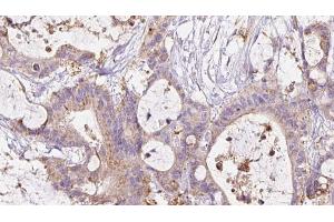 ABIN6267476 at 1/100 staining Human liver cancer tissue by IHC-P. (Cadherin 5 Antikörper  (pTyr731))