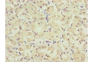 Immunohistochemistry of paraffin-embedded human gastric cancer using ABIN7157234 at dilution of 1:100 (KANSL3 Antikörper  (AA 1-200))
