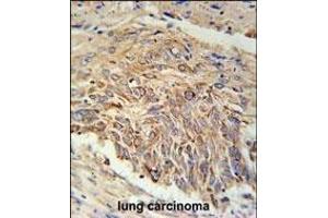 EBPL Antibody (C-term) (ABIN651922 and ABIN2840457) immunohistochemistry analysis in formalin fixed and paraffin embedded human lung carcinoma followed by peroxidase conjugation of the secondary antibody and DAB staining. (EBPL Antikörper  (C-Term))