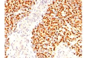 Formalin-fixed, paraffin-embedded human Rhabdomyosarcoma stained with Myogenin Mouse Monoclonal Antibody (F5D) (Myogenin Antikörper  (AA 30-224, AA 73-94, AA 138-158))