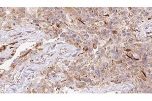 ABIN6278151 at 1/100 staining Human Melanoma tissue by IHC-P. (LGALS1/Galectin 1 Antikörper)