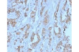 Formalin-fixed, paraffin-embedded human ovarian carcinoma stained. (TDRKH Antikörper)
