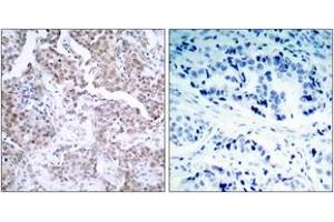 Immunohistochemistry analysis of paraffin-embedded human breast carcinoma, using p53 (Phospho-Ser15) Antibody. (p53 Antikörper  (pSer15))