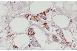 Immunohistochemistry of paraffin-embedded Human mammary cancer using ACSL3 Polyclonal Antibody at dilution of 1:100 (40x lens).